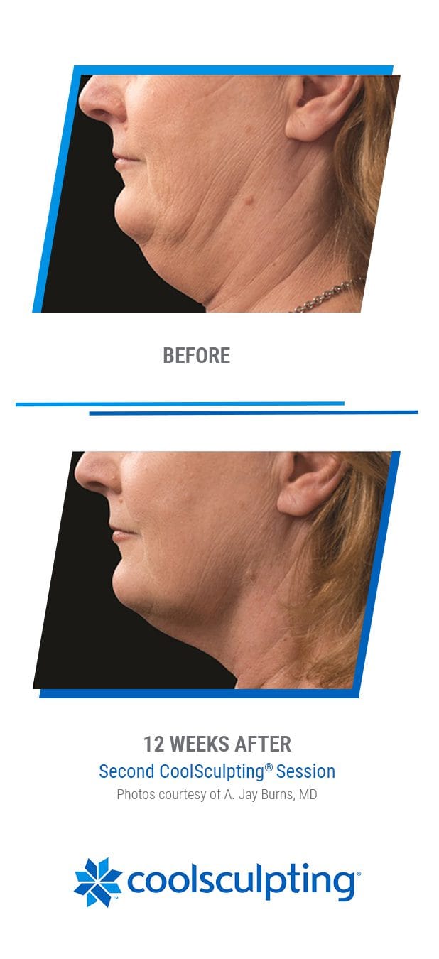 _351464 - CoolSculpting Photos - 1080x1350px v2 -4