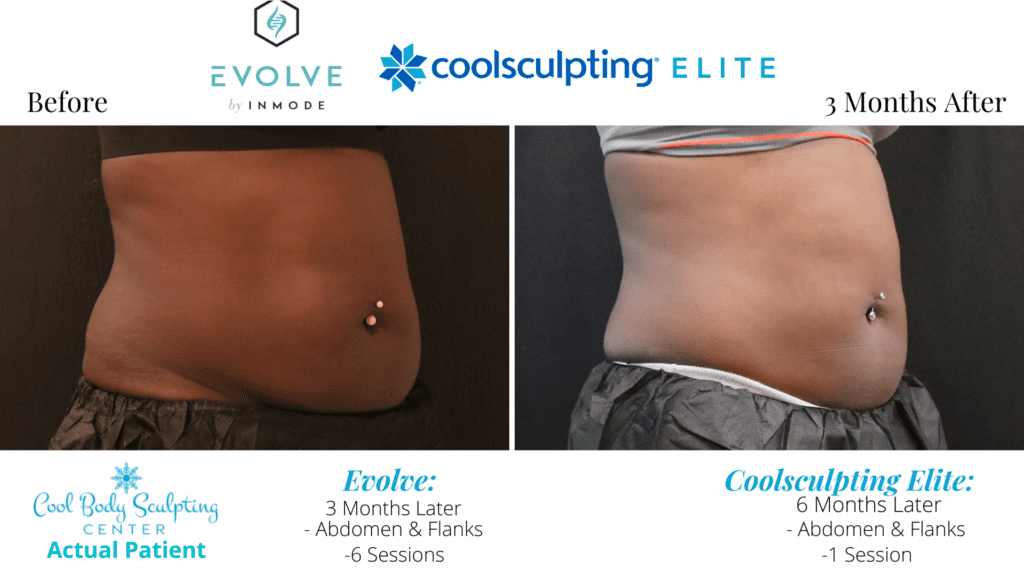 CoolSculpting ELITE Tummy | Cool Sculpting Stomach |