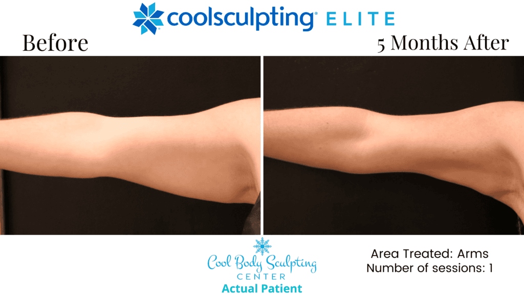 Coolsculpting discount arm fat