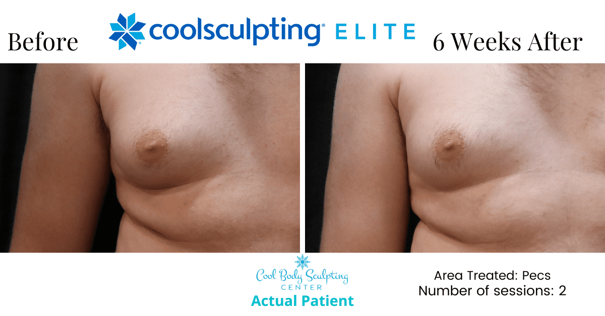 CoolSculpting Elite results