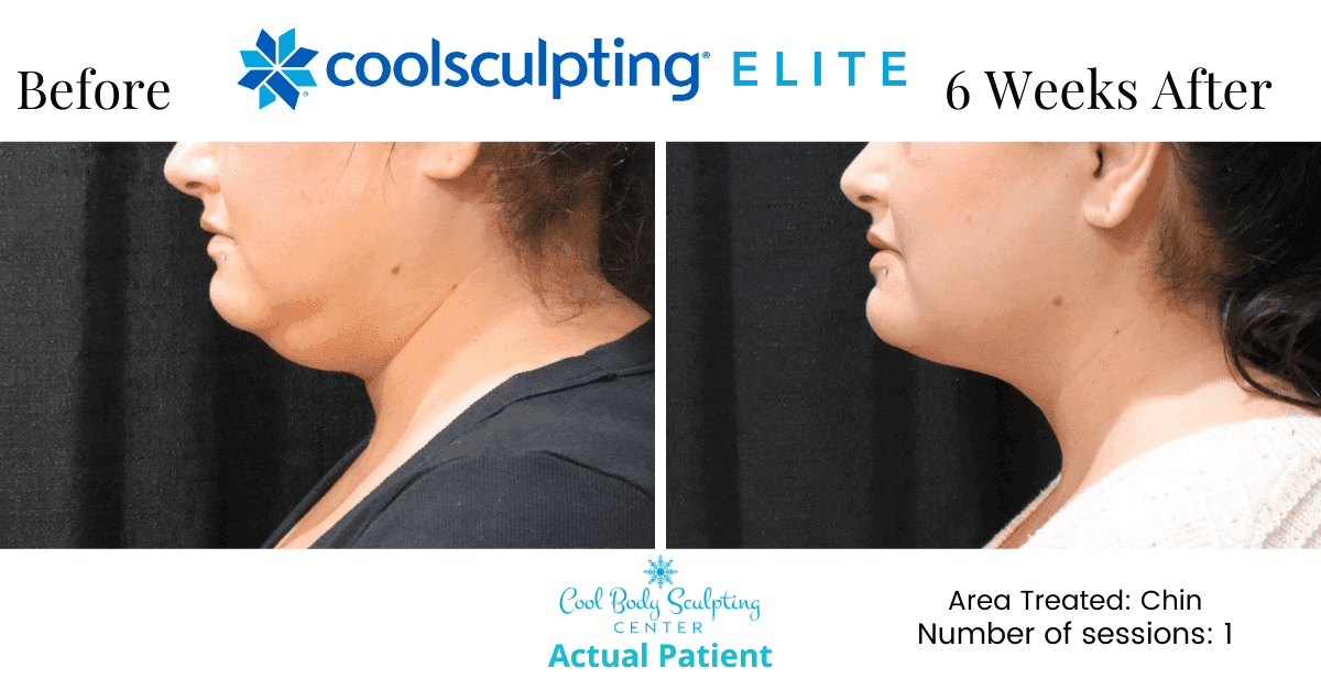 Is CoolSculpting right for your double chin?