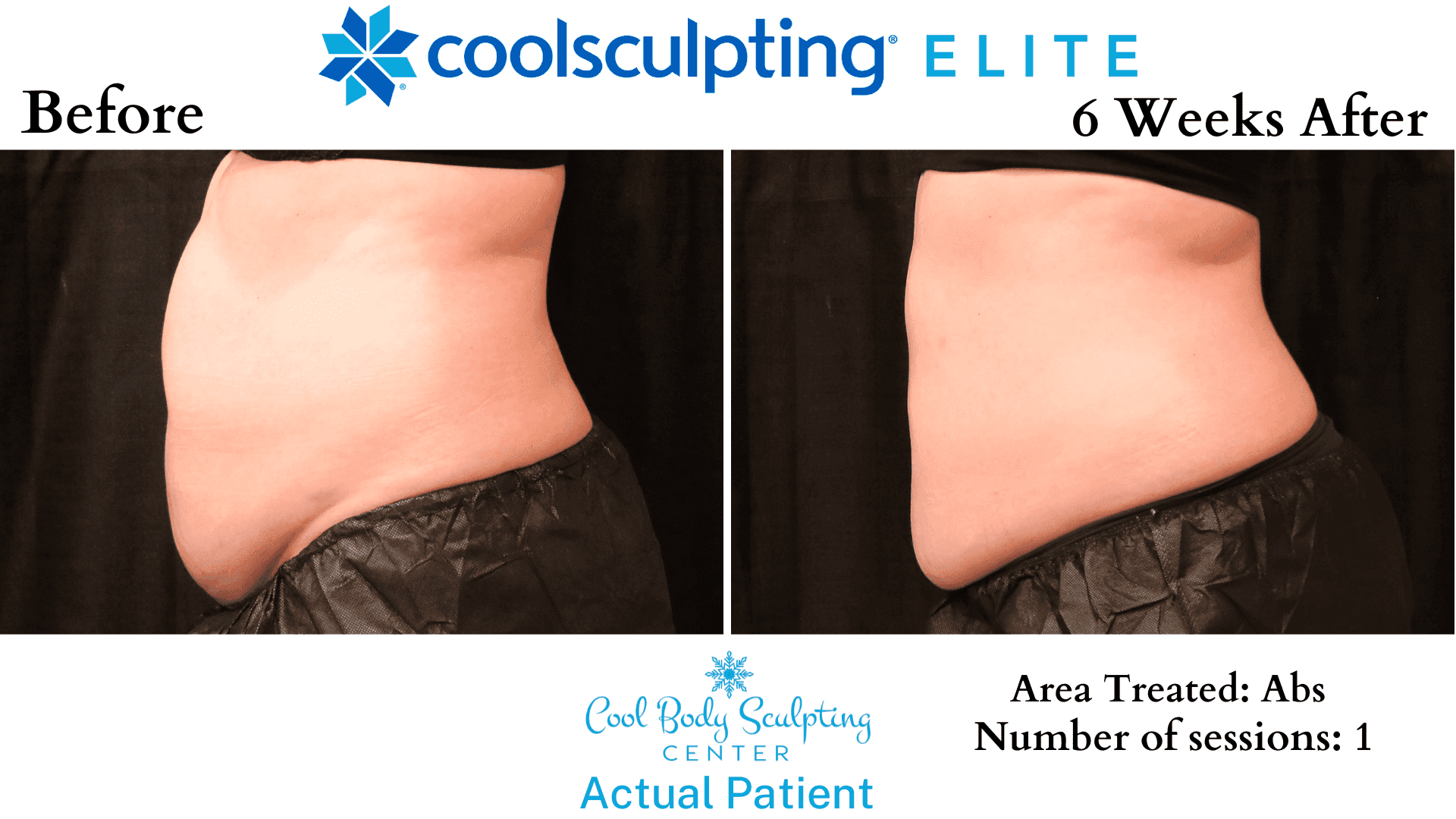 1 CoolSculpting Provider in Hampton Roads - Cool Body Sculpting