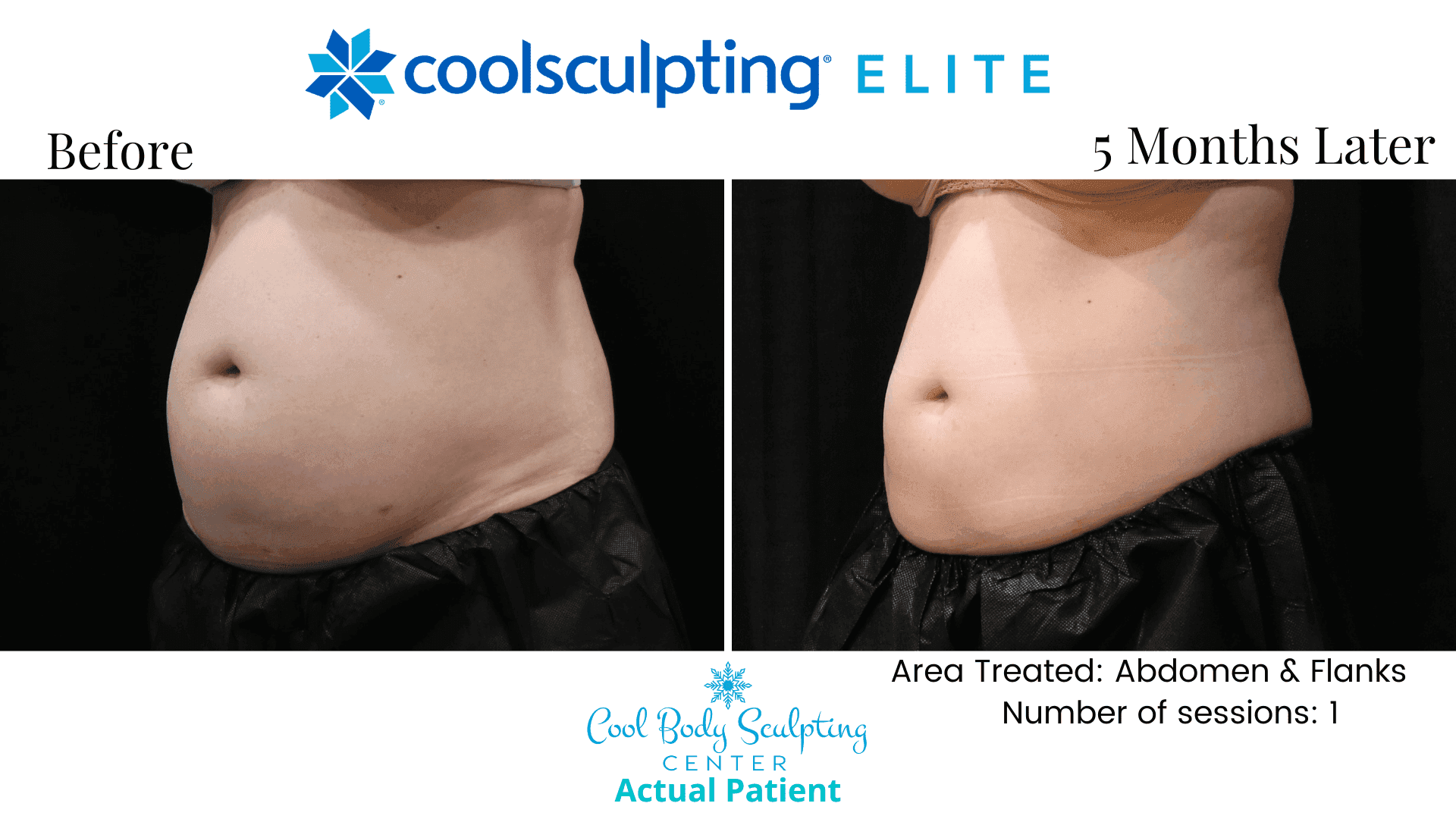 Does CoolSculpting Really Work? CoolSculpting Reviews