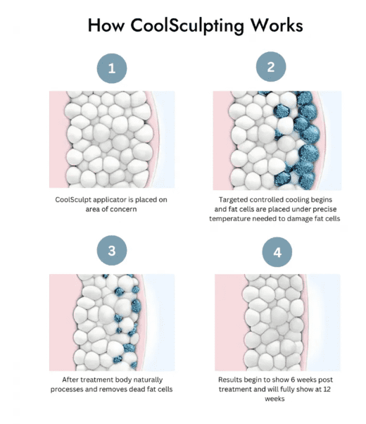 How coolsculpting works