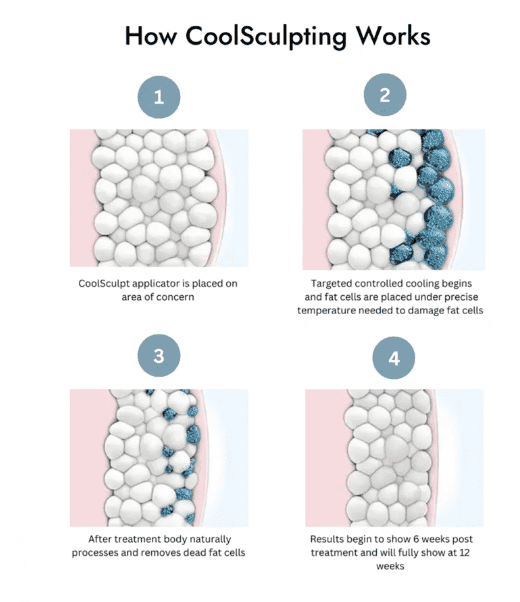 CoolSculpting® How it Works