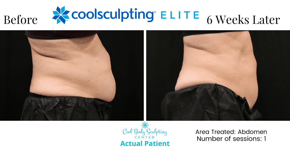 CoolSculpting on tummy