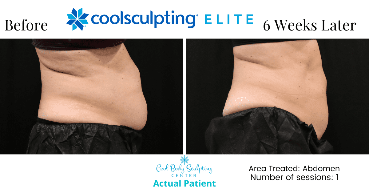 What is CoolSculpting - Cool Body Sculpting Center