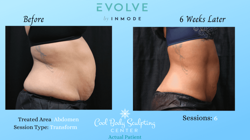 Body contouring results
