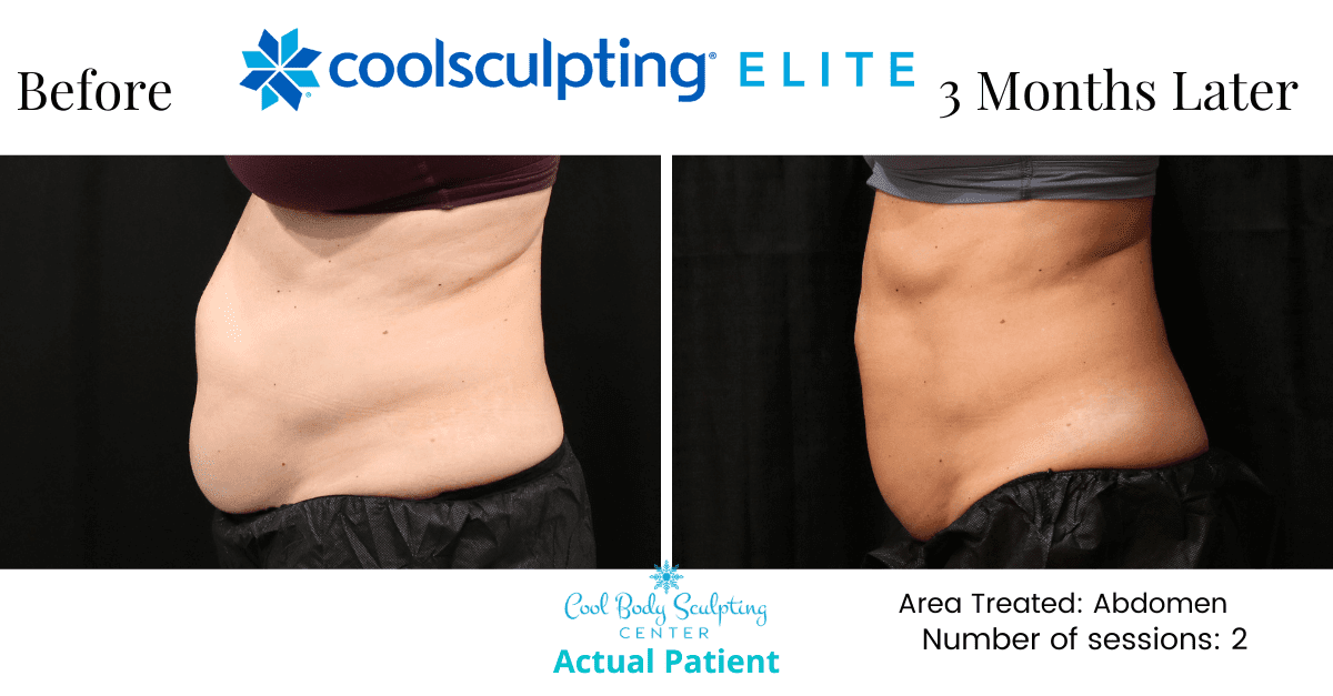 cool sculpting results