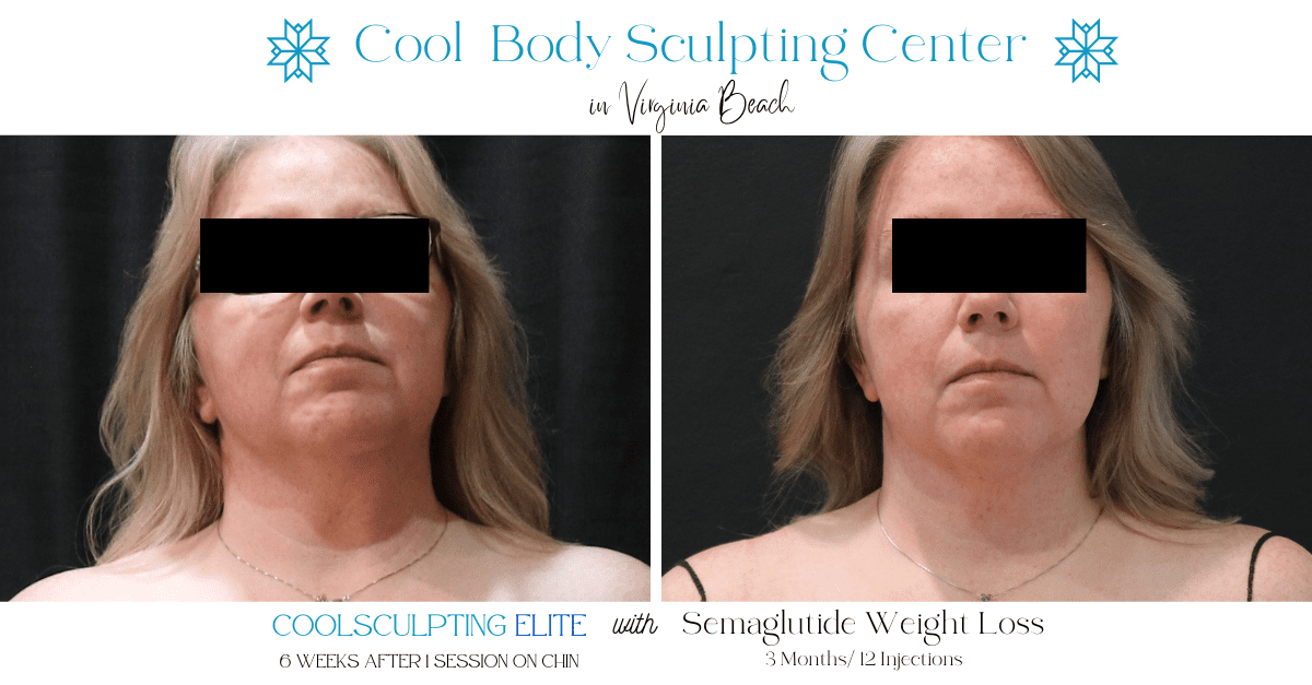 chin lipo, weight loss on face, ozempic virginia beach